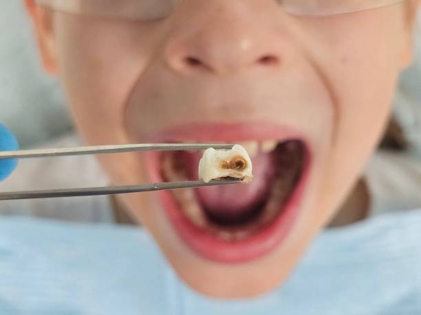 Best Root Canal Emergency Dentist  in Belleair Bluffs, FL